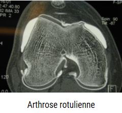 Arthrose de la rotule