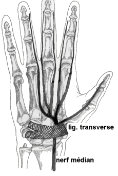 Syndrôme du canal carpien