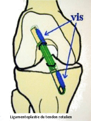 Ligamentoplastie du tendon rotulien