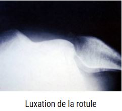 Luxation de la rotule