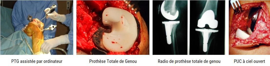 Prothèse totale de genou