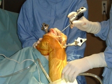 Chirurgie PTG assist�e par ordinateur