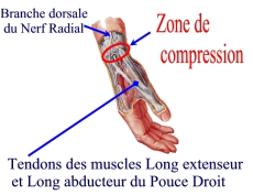 Tendinite de De Quervain