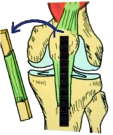 Prélèvement du tendon rotulien